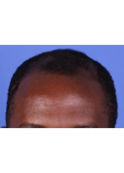 Before Hair Transplant&nbsp;Front